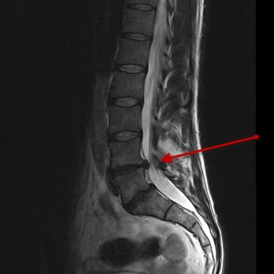 bulging disk on a xray